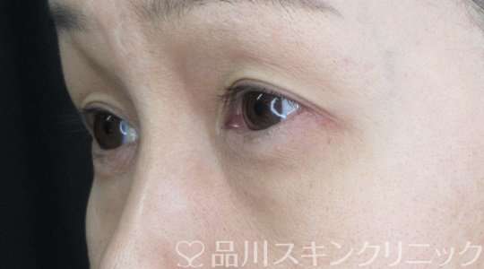 症例NO.68731のBEFORE写真