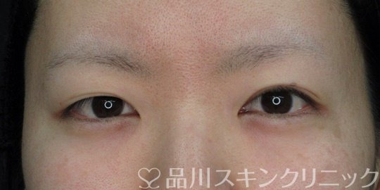 症例NO.72582のBEFORE写真