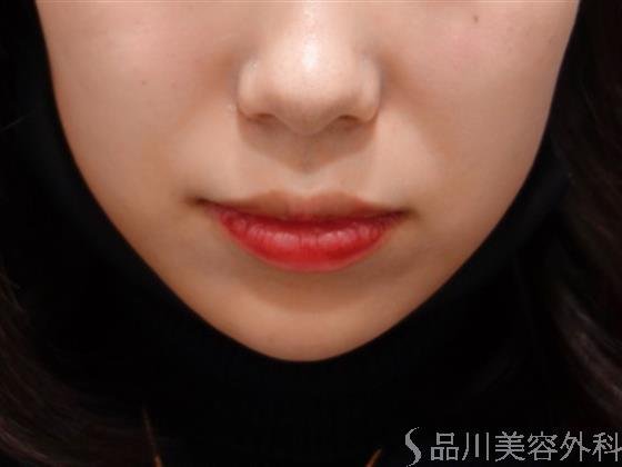 症例NO.50227のBEFORE写真