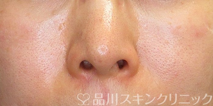 症例NO.74282のBEFORE写真