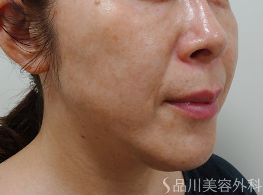 症例NO.72567のBEFORE写真