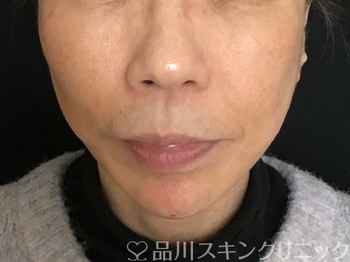 症例NO.65386のAFTER写真