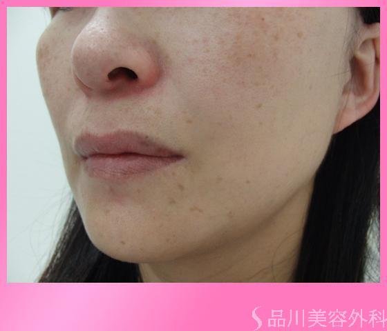 症例NO.4064のAFTER写真