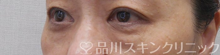 症例NO.70543のBEFORE写真