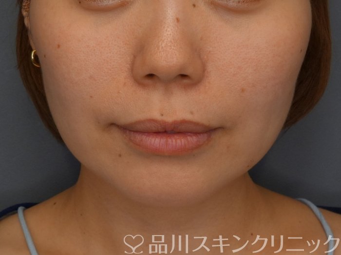 症例NO.74898のBEFORE写真