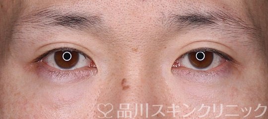 症例NO.74596のBEFORE写真