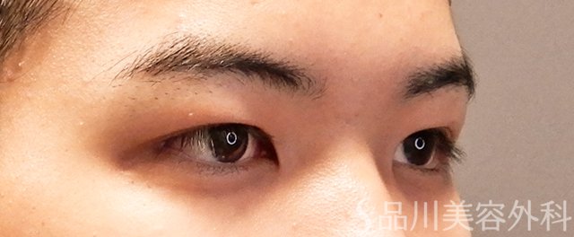 症例NO.71065のBEFORE写真