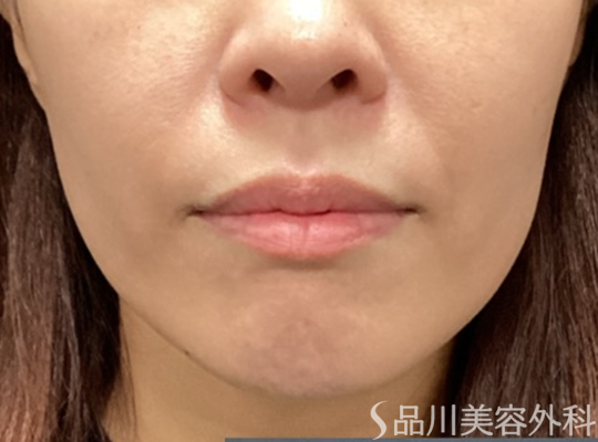 症例NO.74123のBEFORE写真
