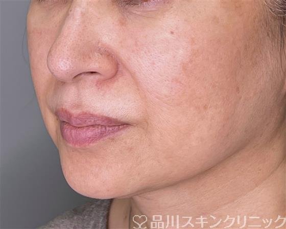 症例NO.55438のBEFORE写真