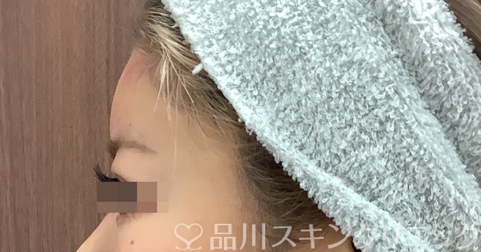 症例NO.69483のAFTER写真