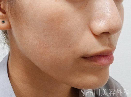 症例NO.68022のAFTER写真