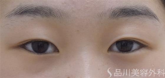 症例NO.52259のBEFORE写真