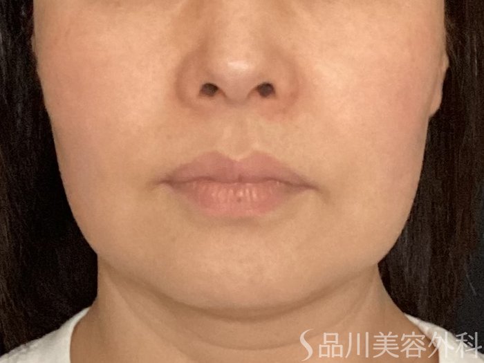 症例NO.65158のBEFORE写真