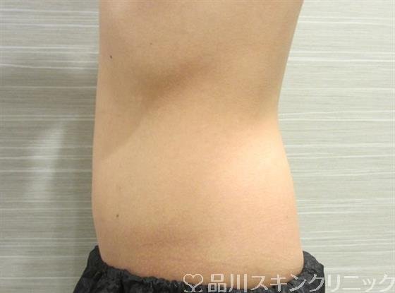症例NO.33132のBEFORE写真