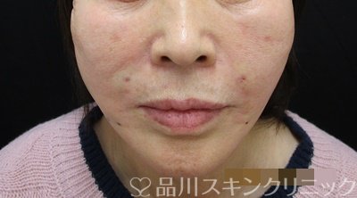 症例NO.64971のAFTER写真