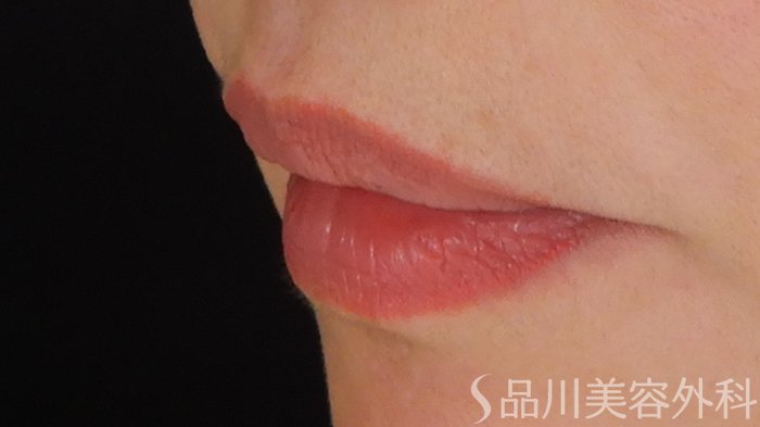 症例NO.69769のBEFORE写真