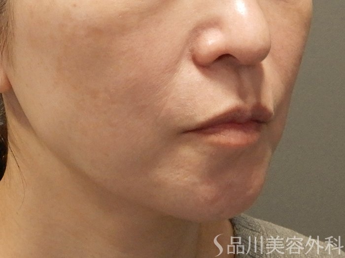 症例NO.70357のBEFORE写真