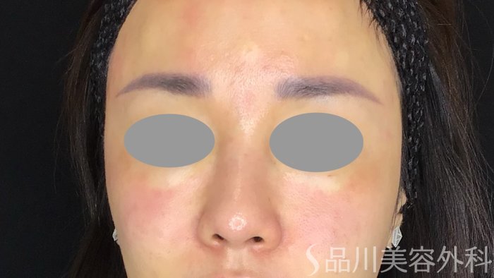 症例NO.67924のAFTER写真