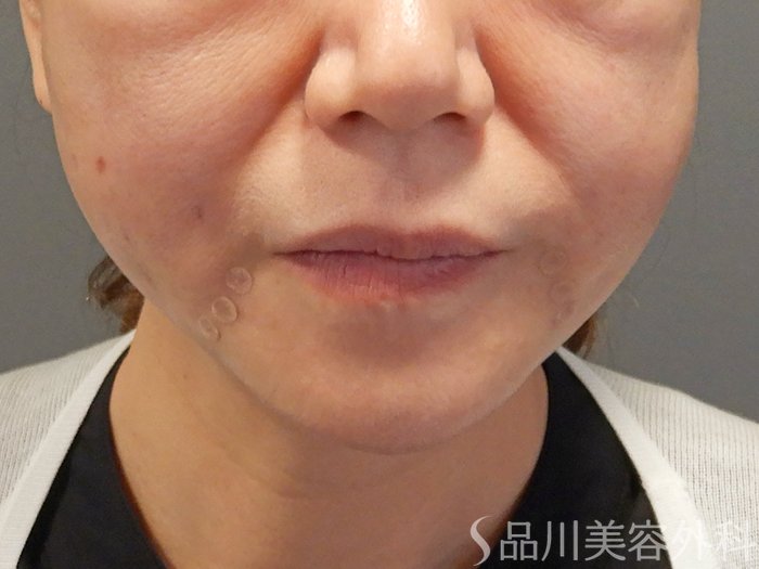 症例NO.71112のAFTER写真