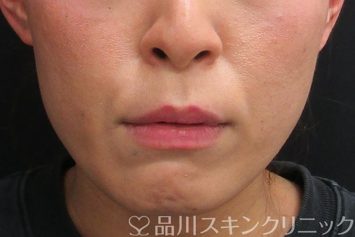症例NO.73996のBEFORE写真