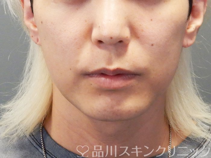症例NO.74370のBEFORE写真