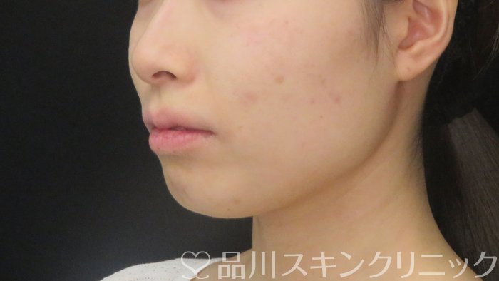 症例NO.72287のAFTER写真