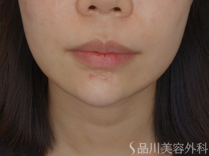 症例NO.72737のAFTER写真