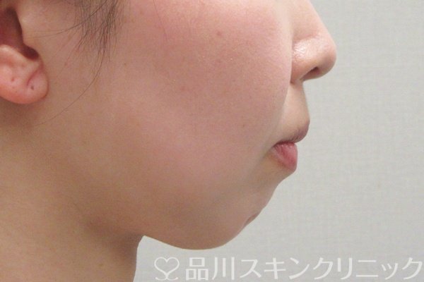 症例NO.74576のBEFORE写真