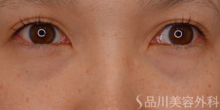 症例NO.65084のBEFORE写真