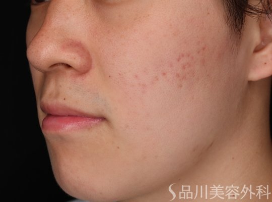 症例NO.70419のBEFORE写真