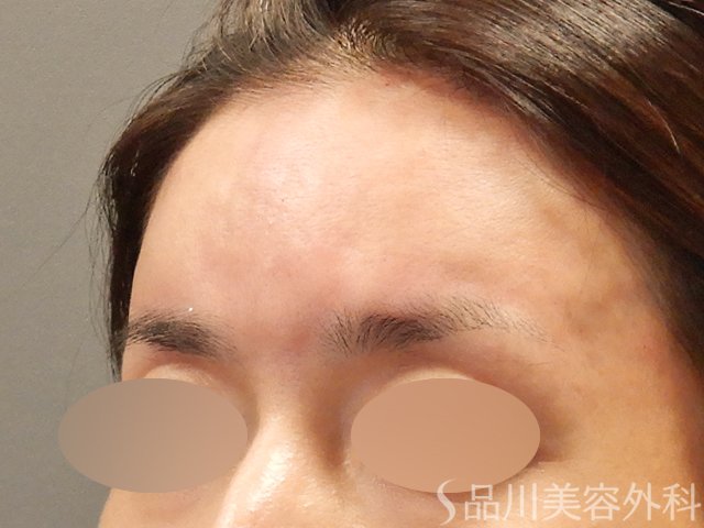 症例NO.71727のAFTER写真