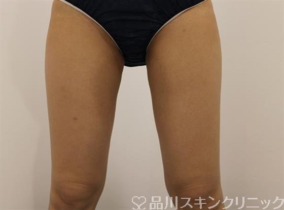 症例NO.44814のAFTER写真