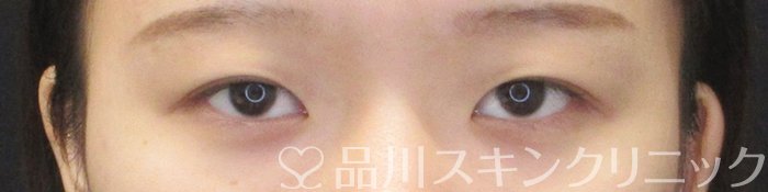 症例NO.64990のBEFORE写真