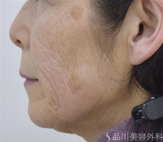 症例NO.50857のBEFORE写真