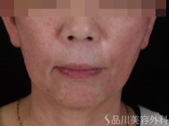 症例NO.72357のAFTER写真