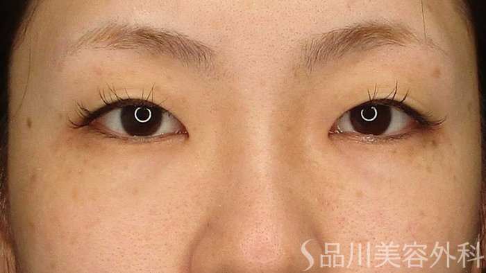 症例NO.67731のBEFORE写真