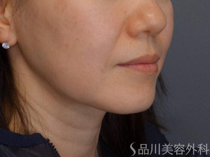 症例NO.74857のBEFORE写真