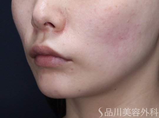 症例NO.74228のAFTER写真