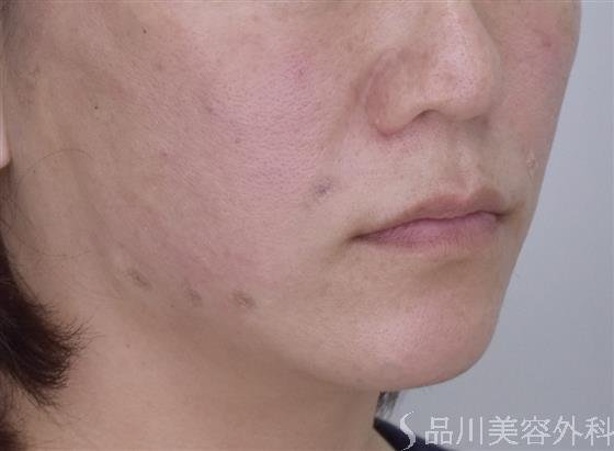 症例NO.50469のAFTER写真