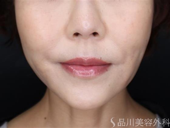症例NO.60238のAFTER写真