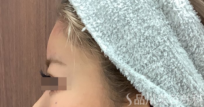 症例NO.69483のAFTER写真