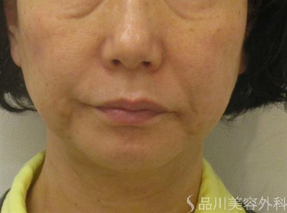 症例NO.48040のAFTER写真