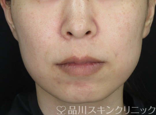 症例NO.70712のBEFORE写真