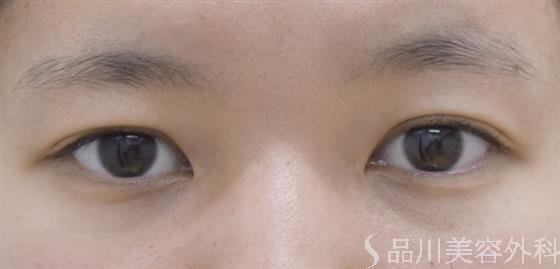 症例NO.52539のBEFORE写真