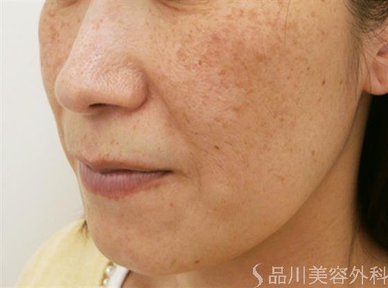 症例NO.31581のBEFORE写真