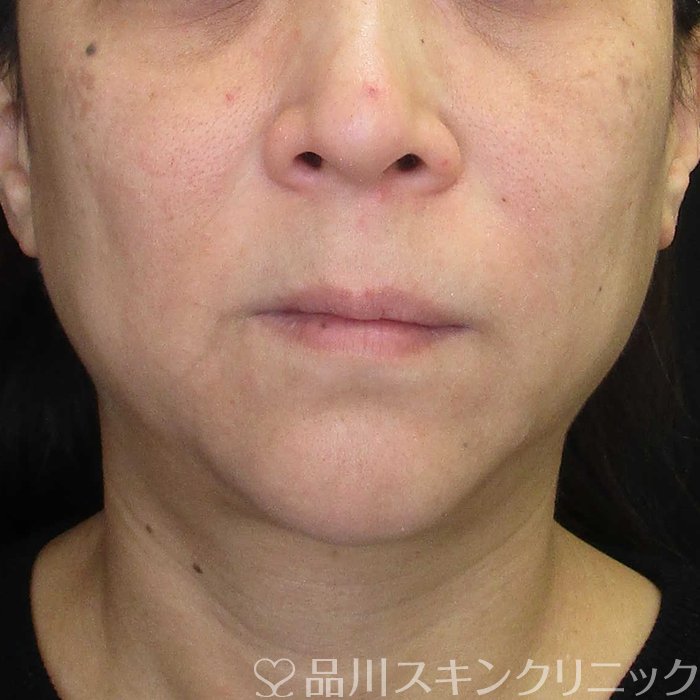 症例NO.70424のBEFORE写真