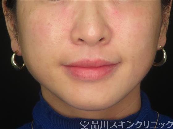症例NO.59581のAFTER写真
