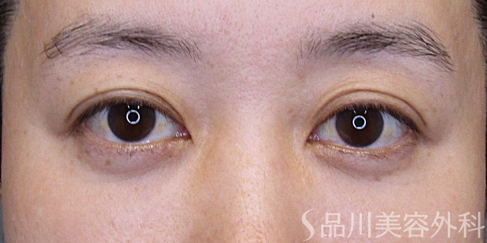 症例NO.75203のBEFORE写真