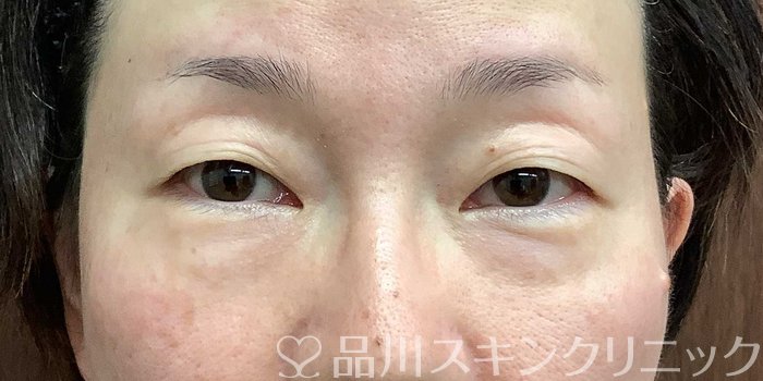 症例NO.71292のBEFORE写真