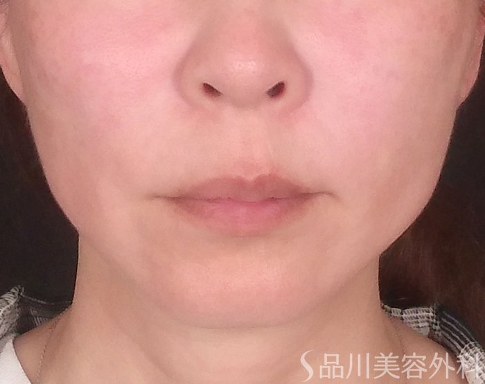 症例NO.71012のBEFORE写真